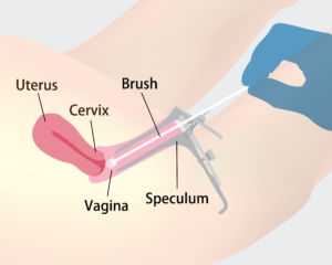 cervical cancer and DNA testing